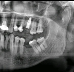 Immediate Tooth Extraction and Implant Placement – Faster, Predictable, and Aesthetic Tooth Replacement tandimplantat Malmö